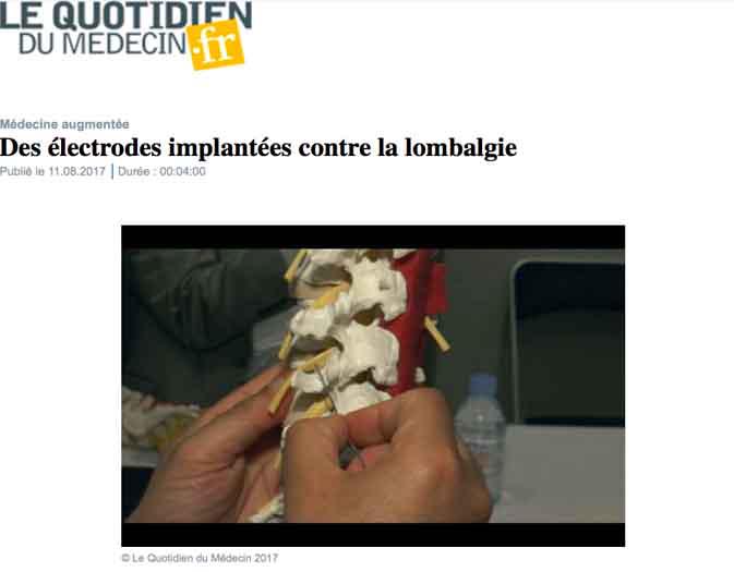 Electrodes implantées contre les lombalgies (Juin 2017)